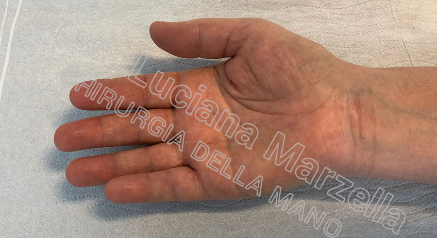 https://www.marzellachirurgiadellamano.com/wp-content/uploads/2021/03/sindrome-del-tunne-carpale_2-mesi-900x490.jpg