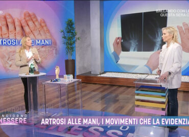 artrosi delle mani (3)