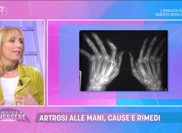 Artrosi delle mani: cause e rimedi