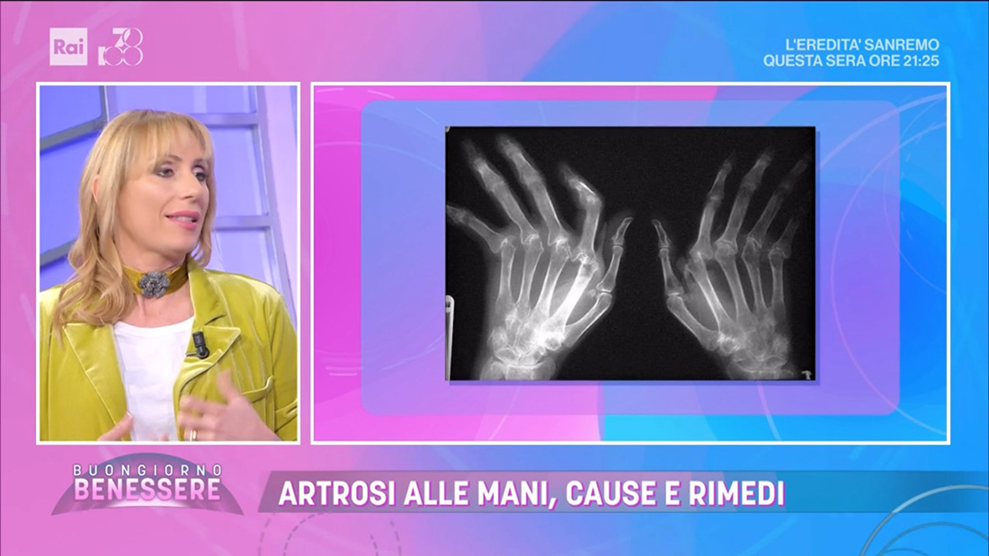 Artrosi delle mani: cause e rimedi